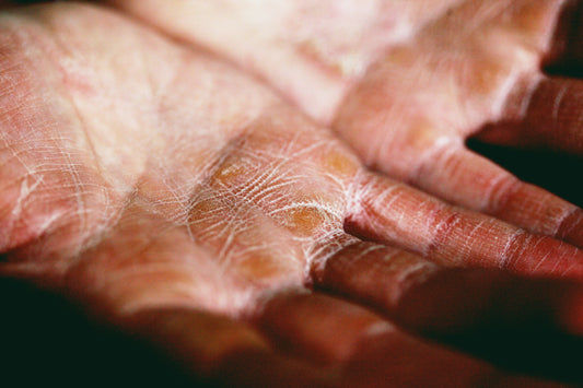 Ashy hands without body butter